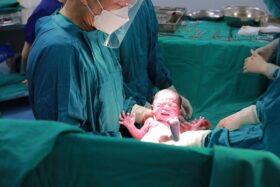 Geburt via Kaiserschnitt. Der Chirurg hält das Baby in den Händen.